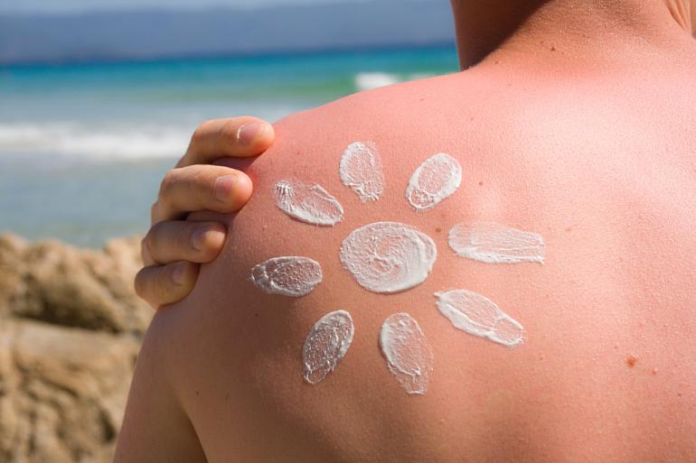 Защита кожи от ожогов: советы, которые реально работают | Vegetarian.ru