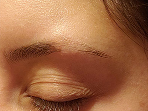 Losing Eyebrow Hair? Try Homeopathy Treatment!