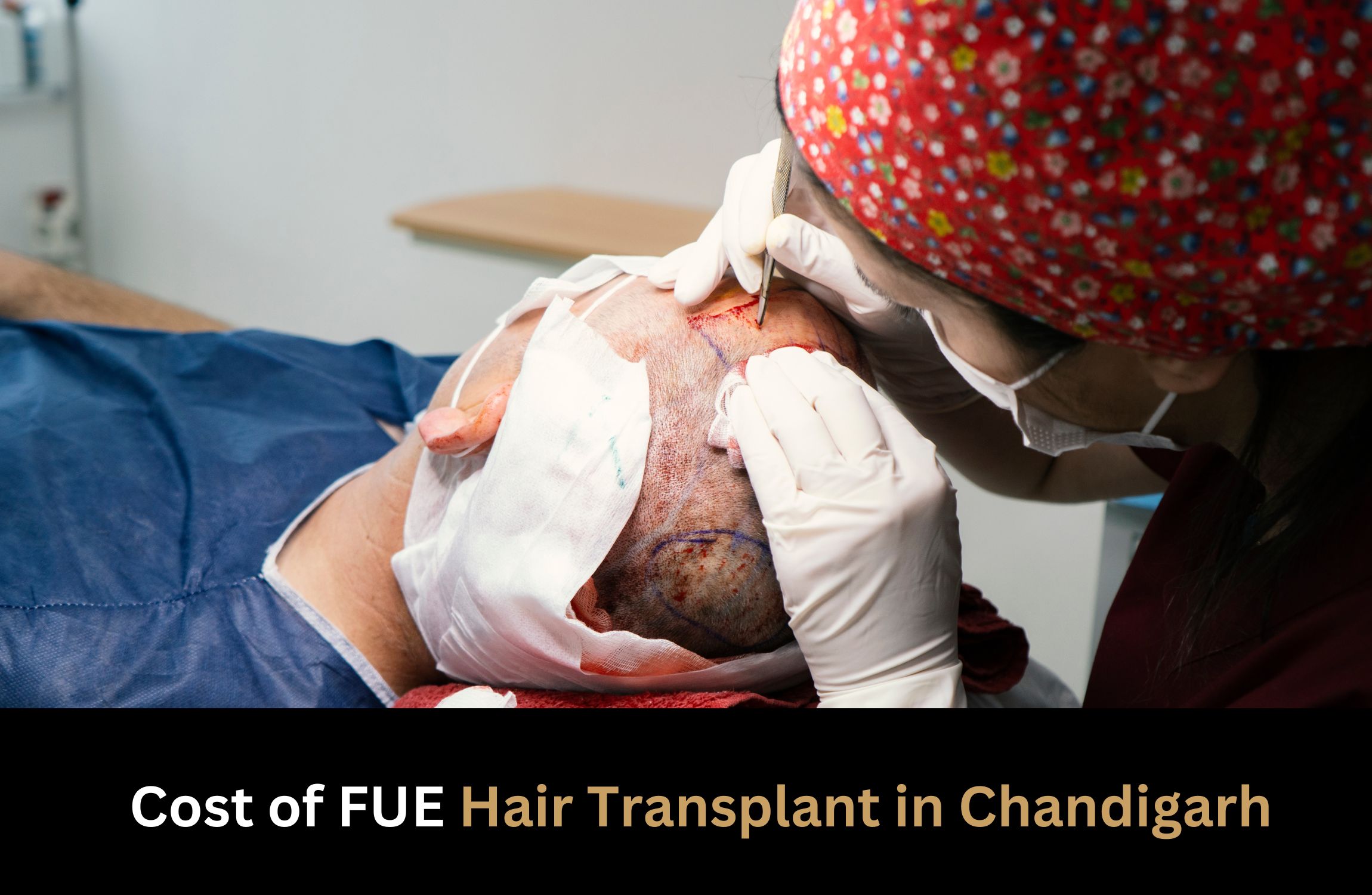 Cost of FUE hair transplant in Chandigarh - VIZOX CLINIQUE